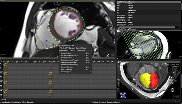 Circle Cardiovascular Imaging CVI42(心血管后期处理软件)下载 v5.1.1官方版